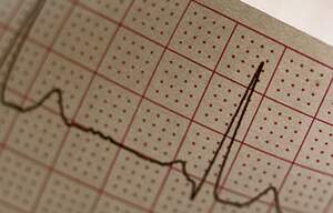 EKG graph